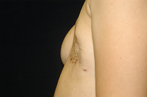 Breast Reconstruction 1c